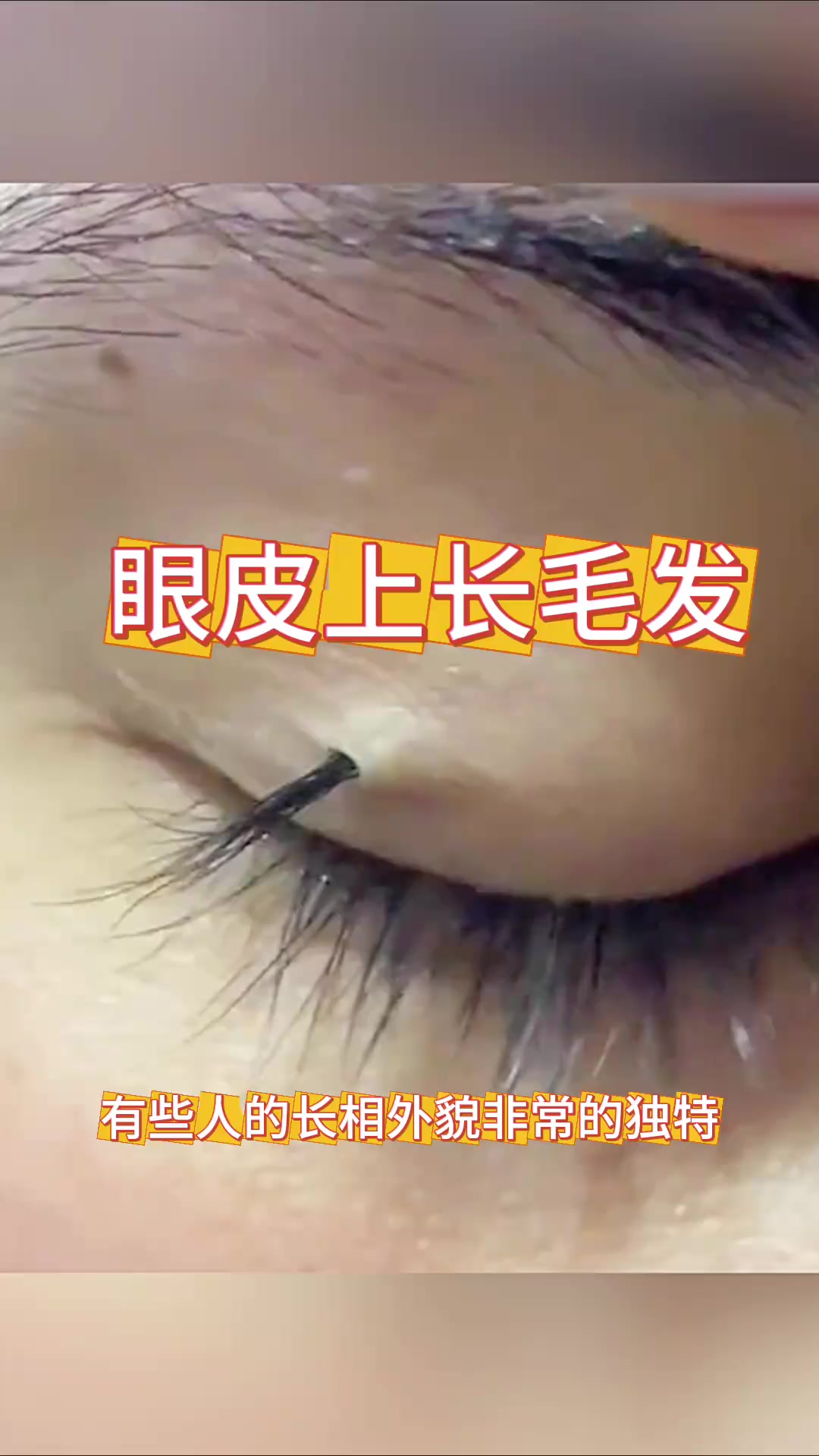 眼皮竟长黑色毛发,难道是自然奇观还是未解之谜?