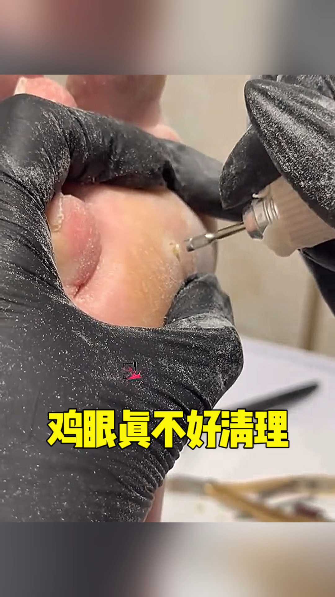 鸡眼真不好清理呀