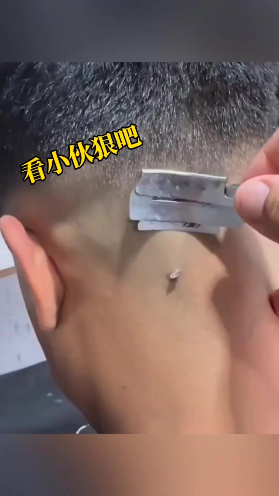 “头顶肉瘤患者的奇异遭遇：刀片与美的冲突引发悬念”