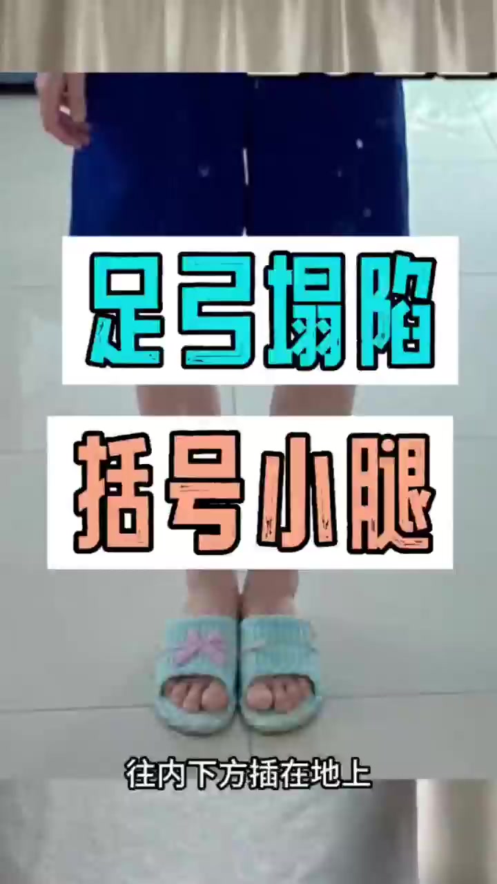 足弓塌陷,小腿外翻括号腿,是因为臀大肌无力吗?!