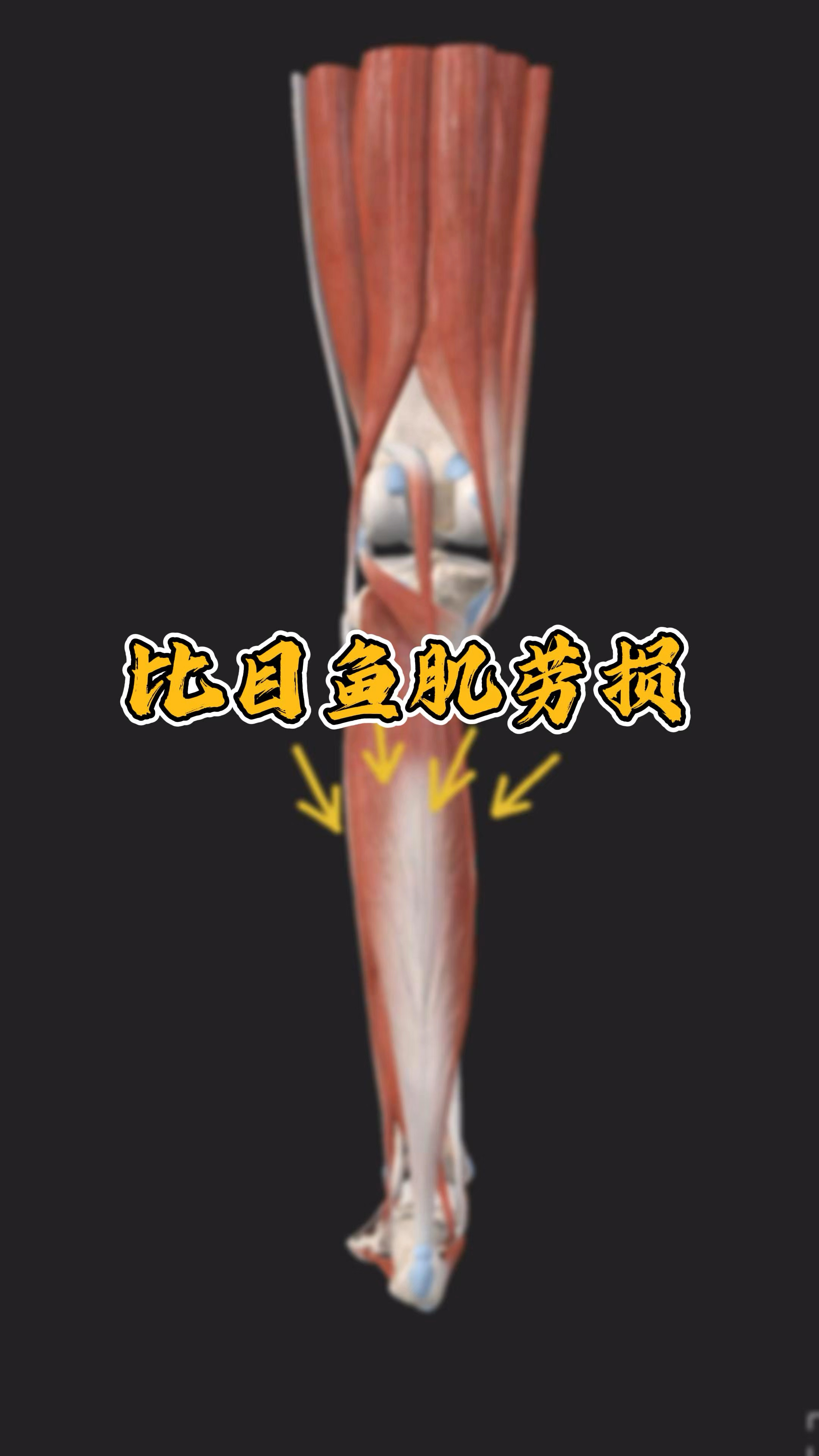 小腿酸痛找不到原因？一分钟自测比目鱼肌是否损伤！