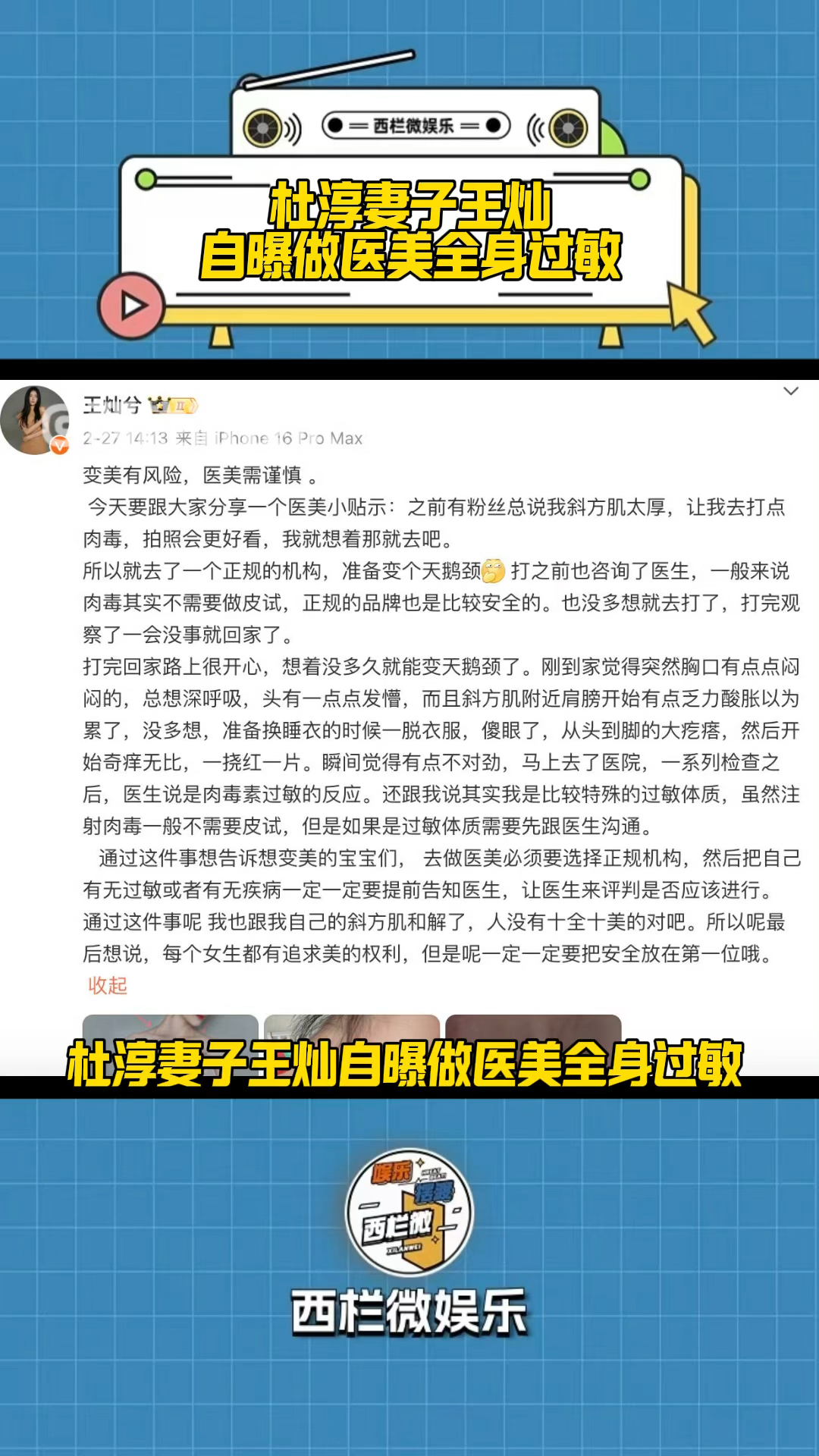 杜淳妻子自曝注射肉毒素,结果导致全身过敏,起红疹胸口发闷