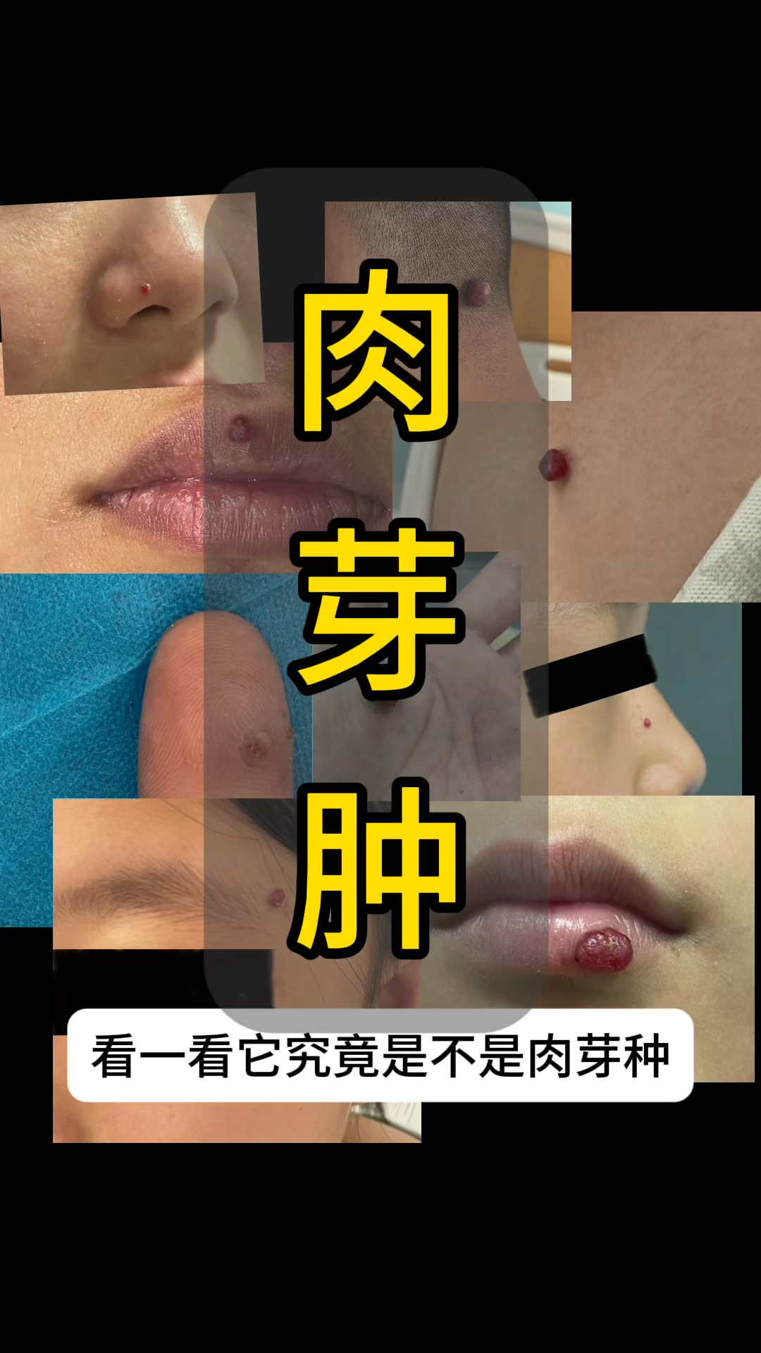如何早期认识肉芽肿
