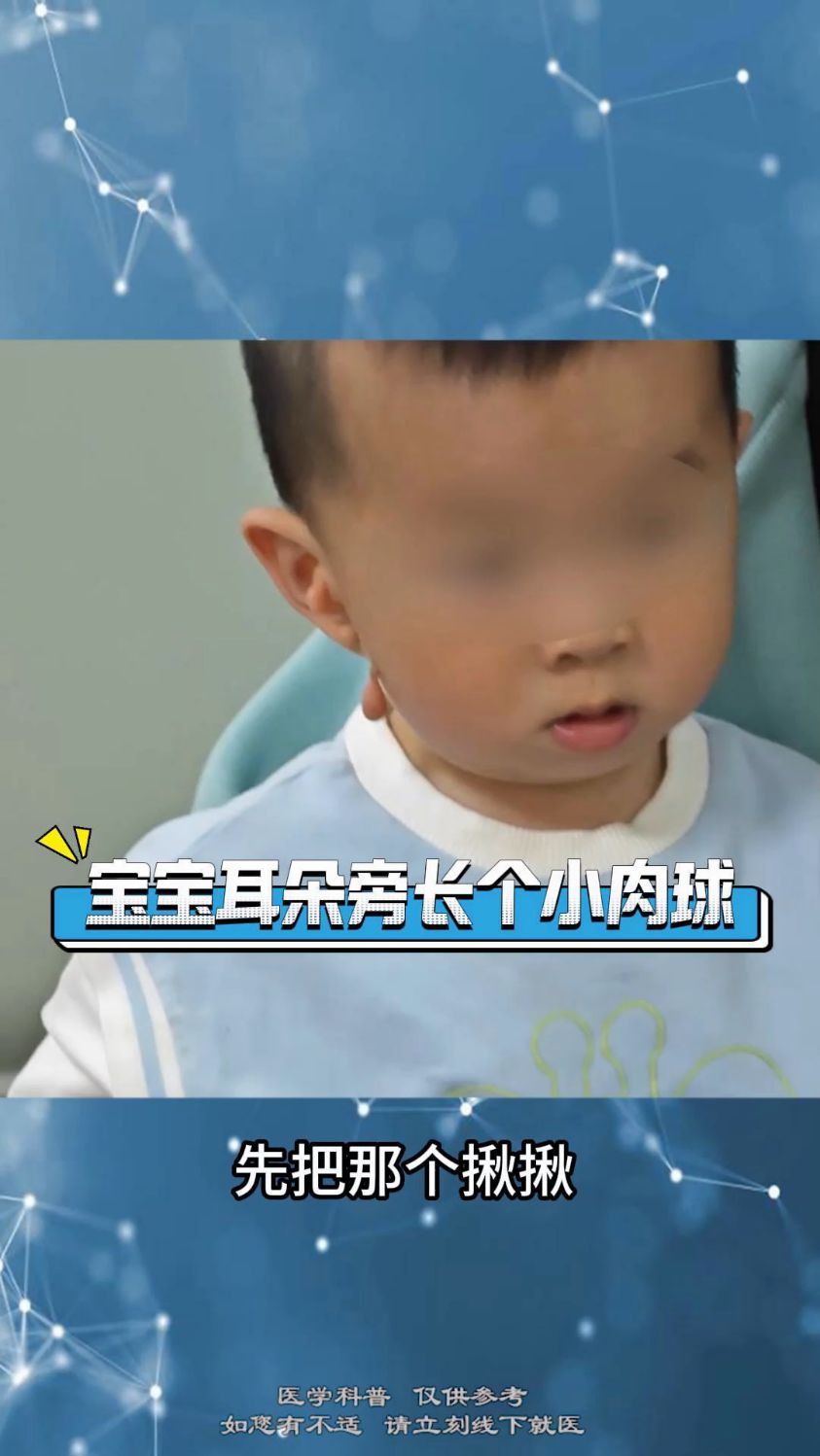 宝宝耳朵旁长个小肉球 #科普 #附耳 #附耳宝宝