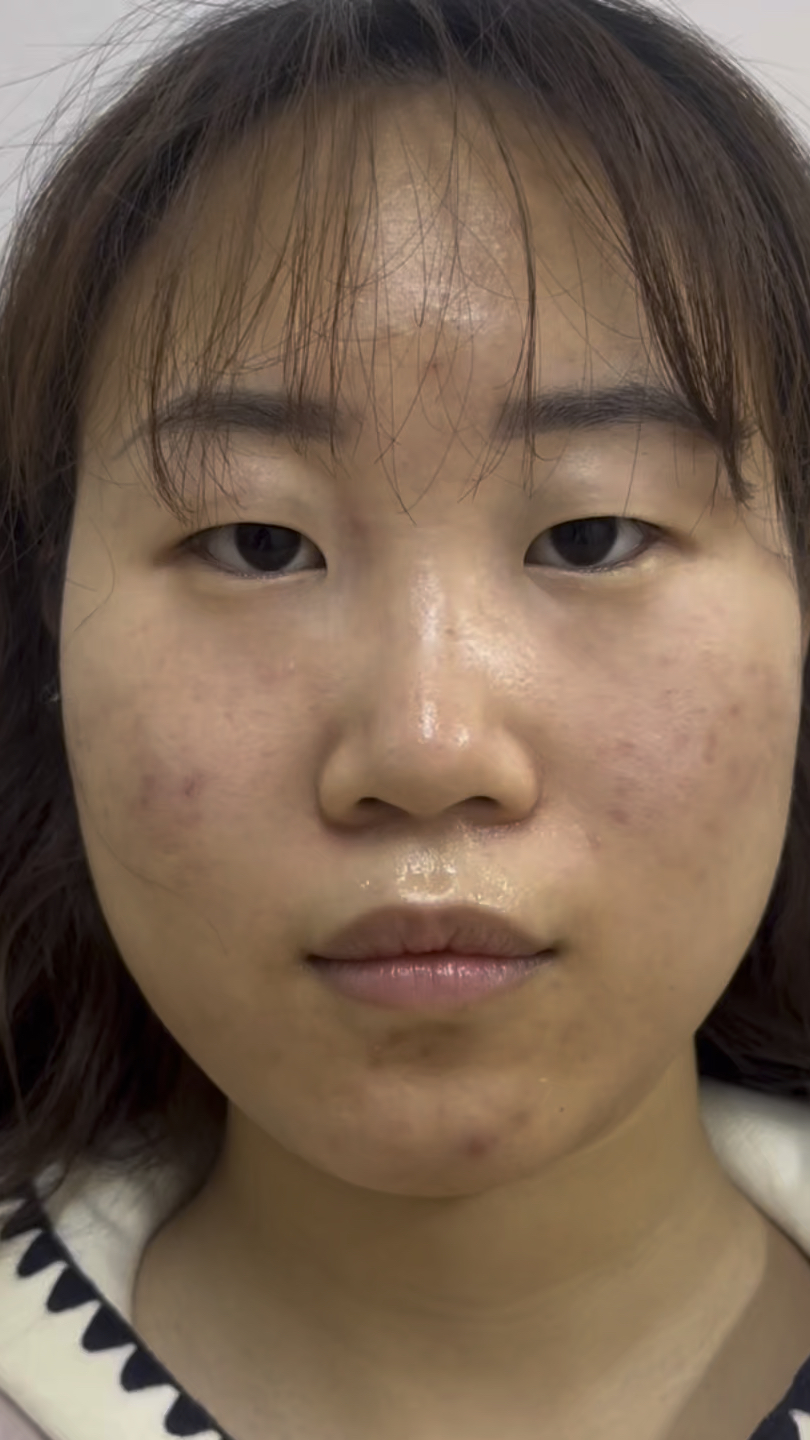 双眼皮手术7天后拆线了