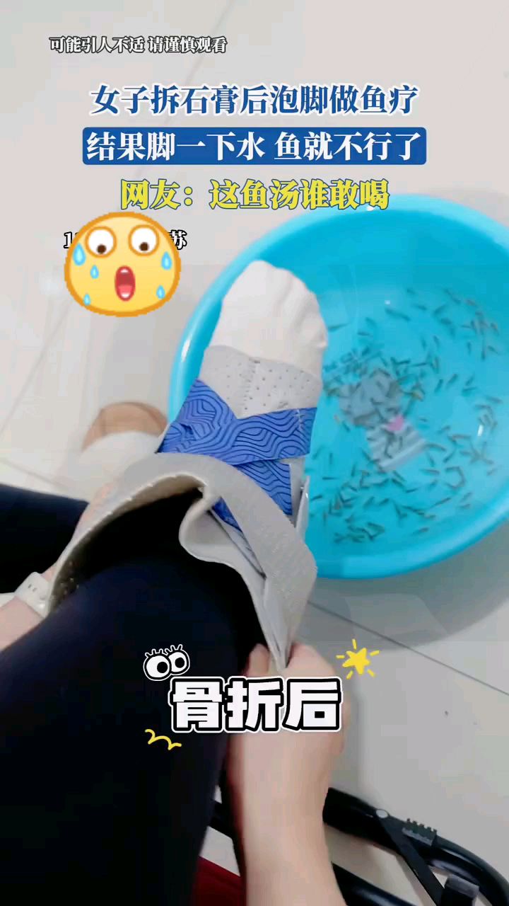 女子拆石膏后泡脚做鱼疗