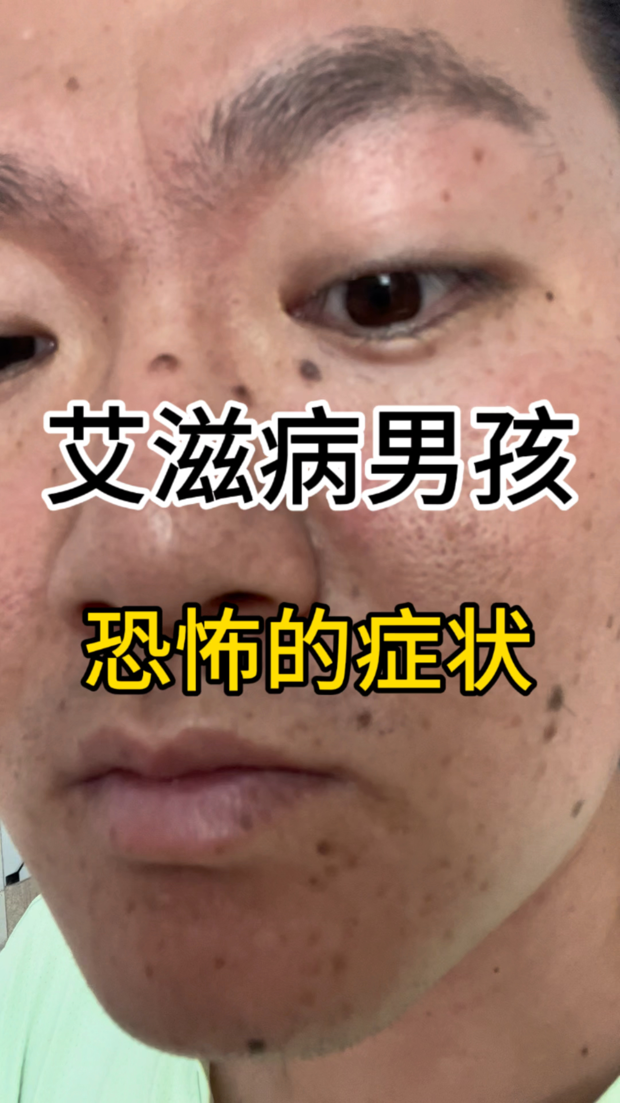 得艾滋病七年多了，脸上的症状严重了，这是卡波西肉瘤，属于肿瘤