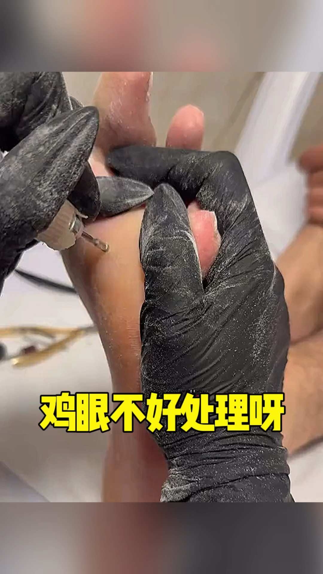 鸡眼真是不好处理呀