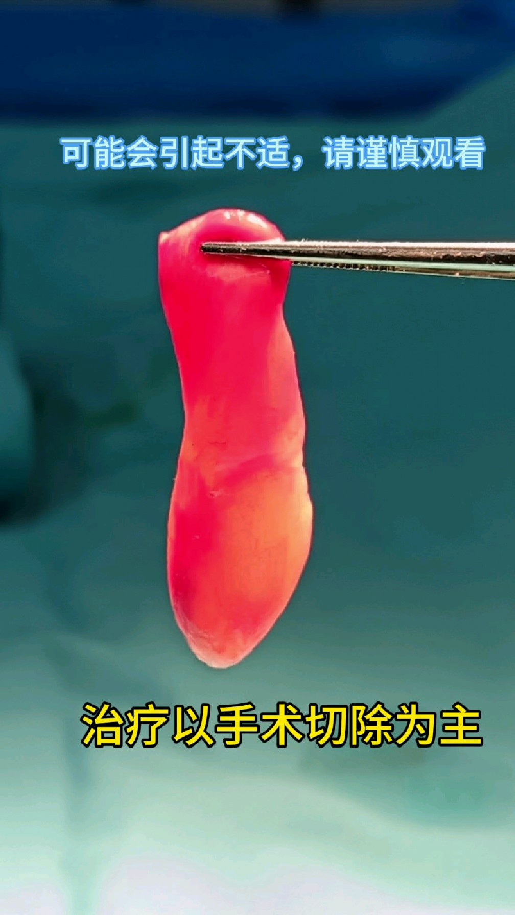 儿童后鼻孔息肉,少见易复发,图片可能引起不适,请谨慎观看