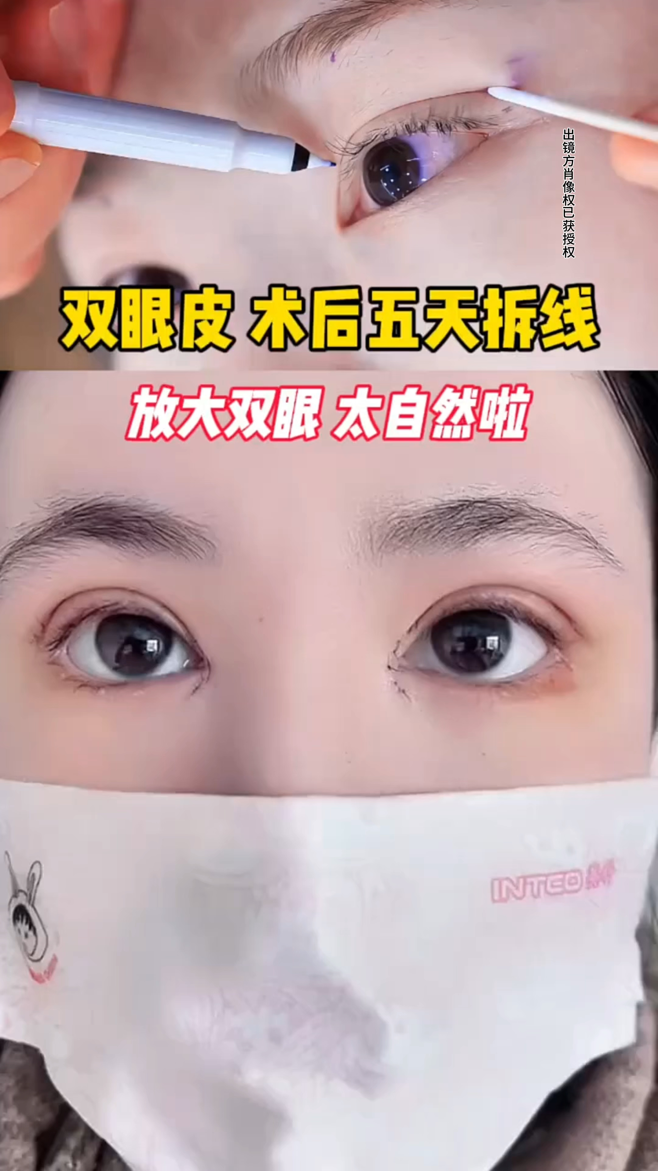 双眼皮术后第五天拆线,放大双眼太自然了