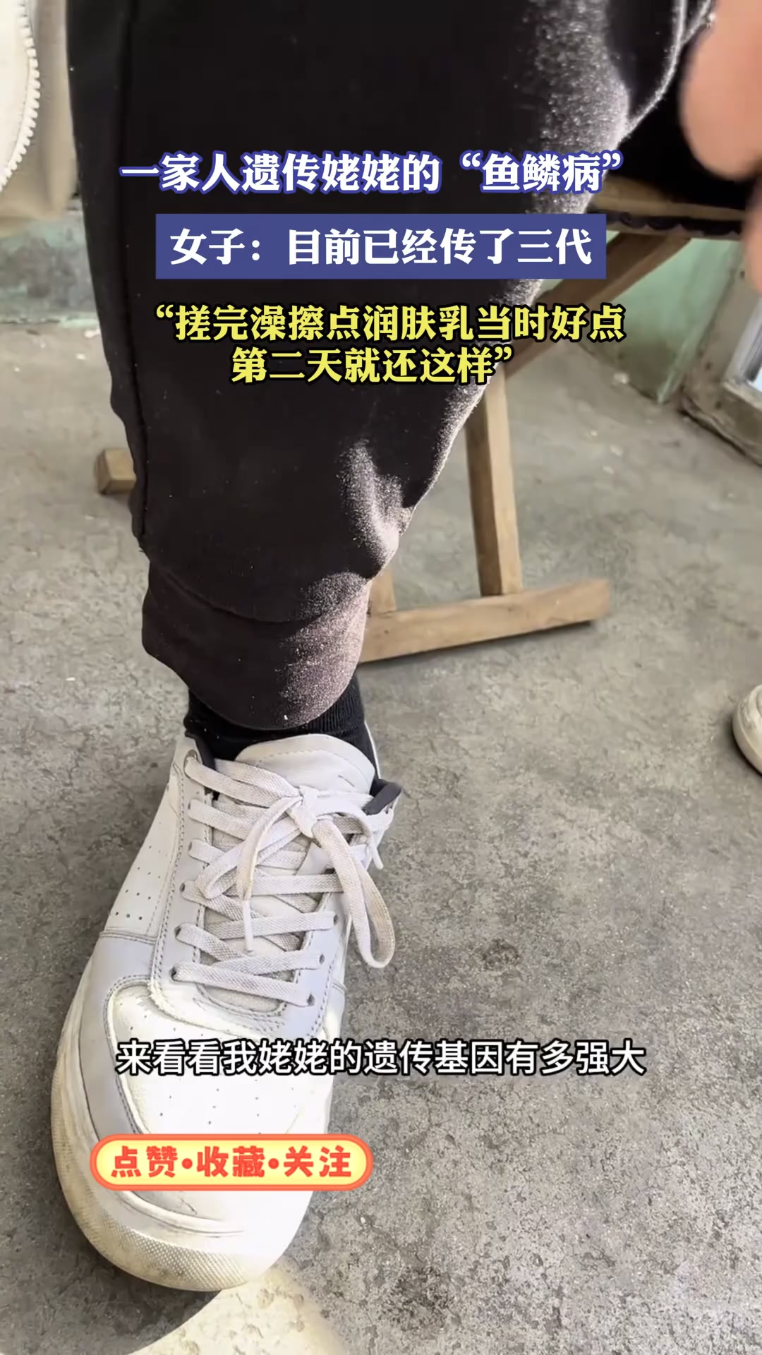 三代人遗传“鱼鳞病”，女子无奈：搓澡润肤仅能短暂缓解