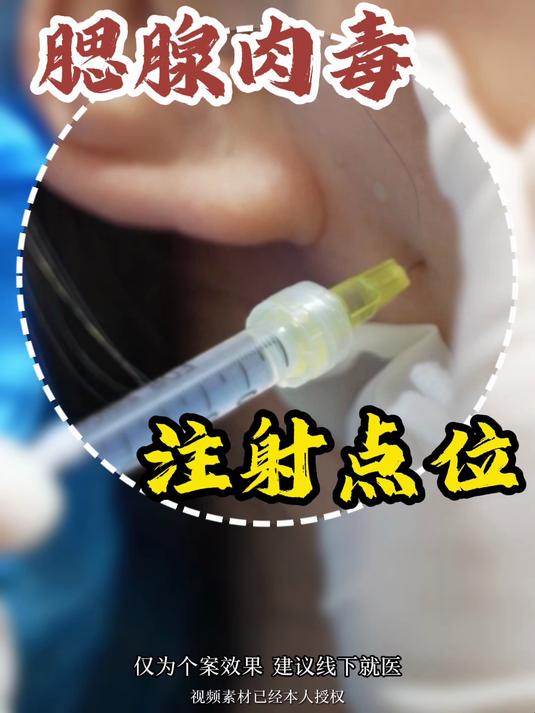 肉毒素注射腮腺注射点位和方式!
