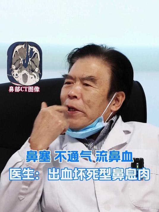 鼻塞 不通气 流鼻血 医生:出血坏死型鼻息肉#医学科普#热点