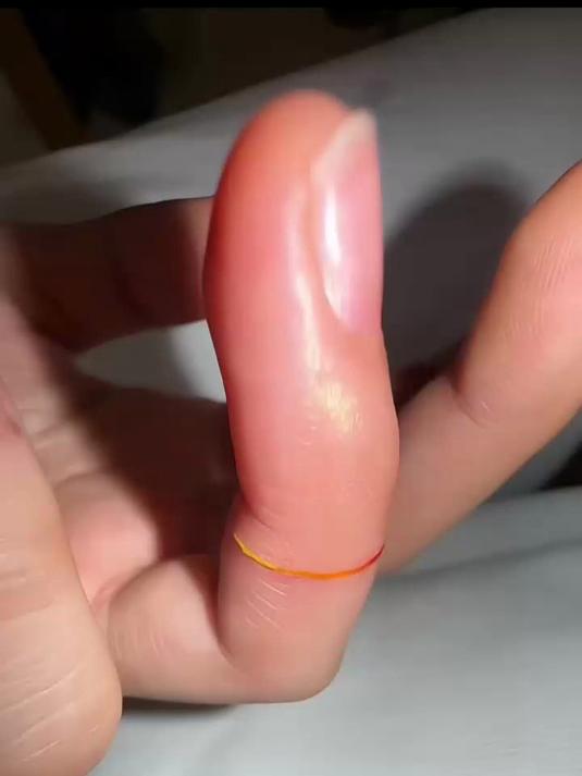 手指上突然长出一个圆环，我这是得了什么怪病？