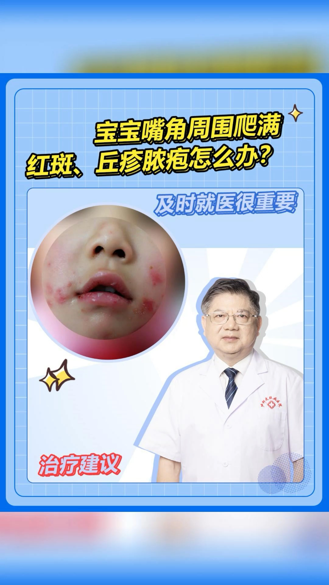 宝宝嘴角周围爬满红斑丘疹脓疱疹怎么办?