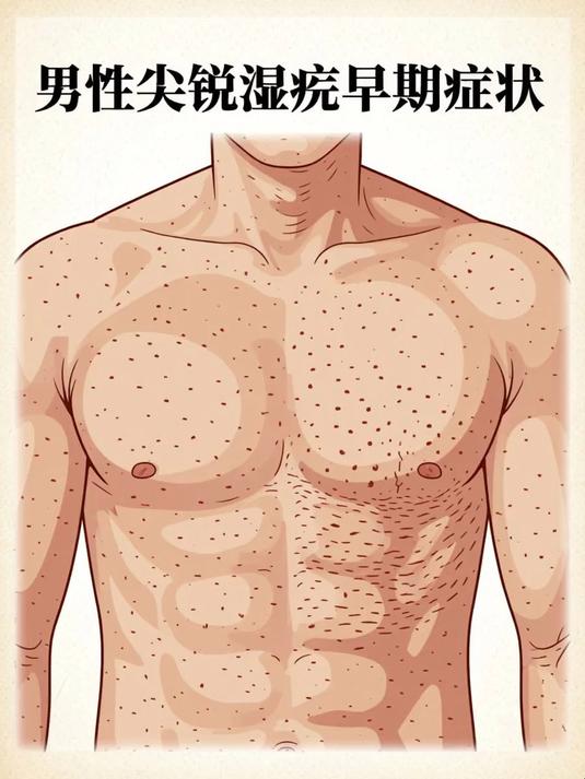 男性湿锐疣早期症状 #健康扬帆季#