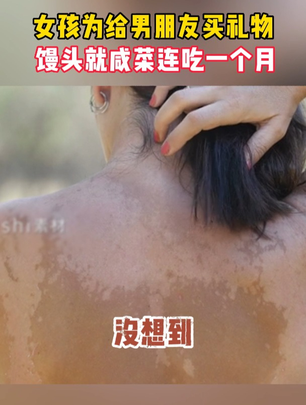 女孩为给男朋友买礼物,馒头就咸菜引发白癜风