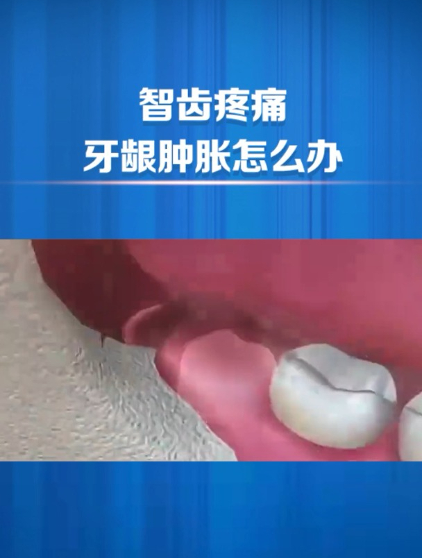 智齿痛起来要命!牙龈都肿了怎么办?