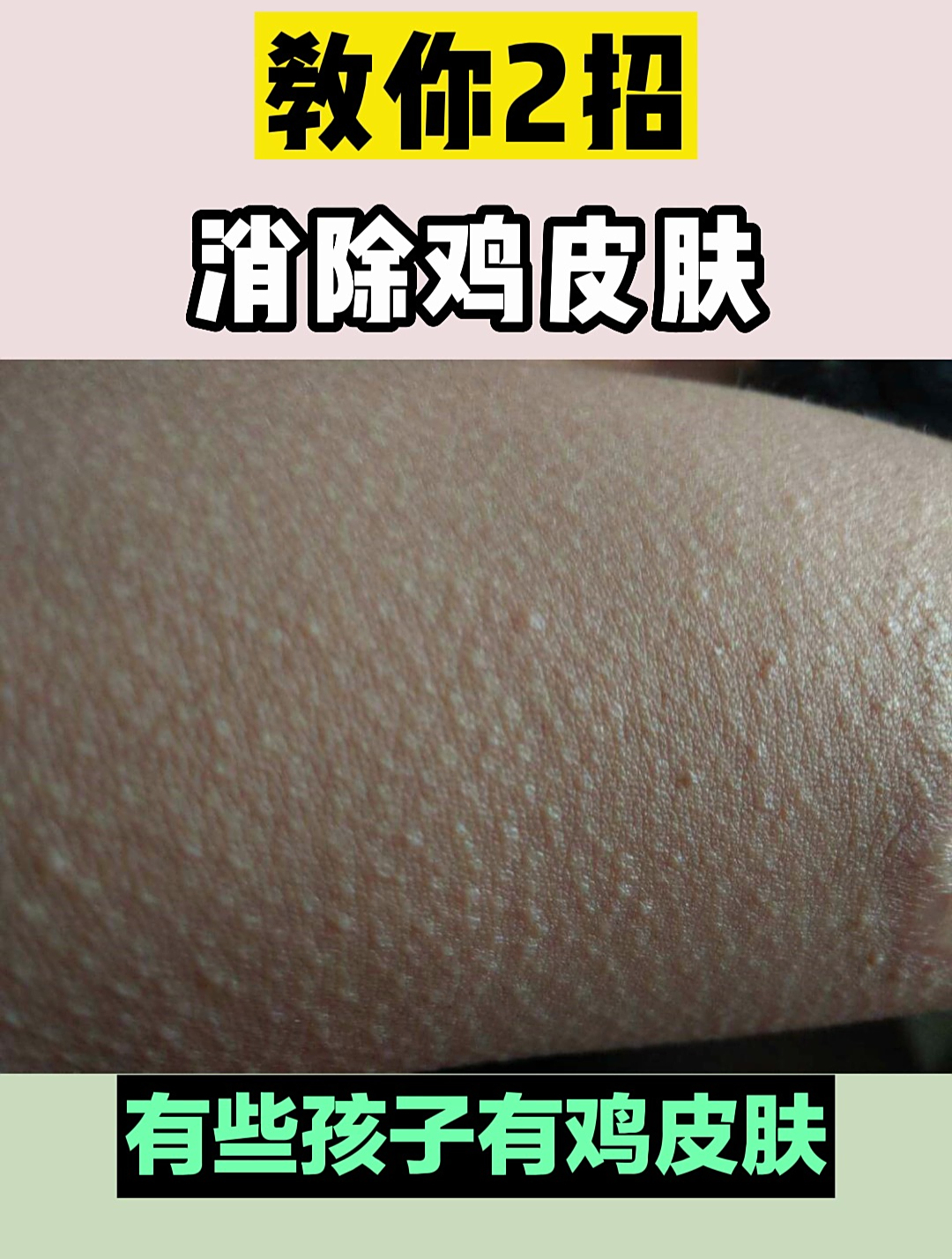 教你2招 消除鸡皮肤