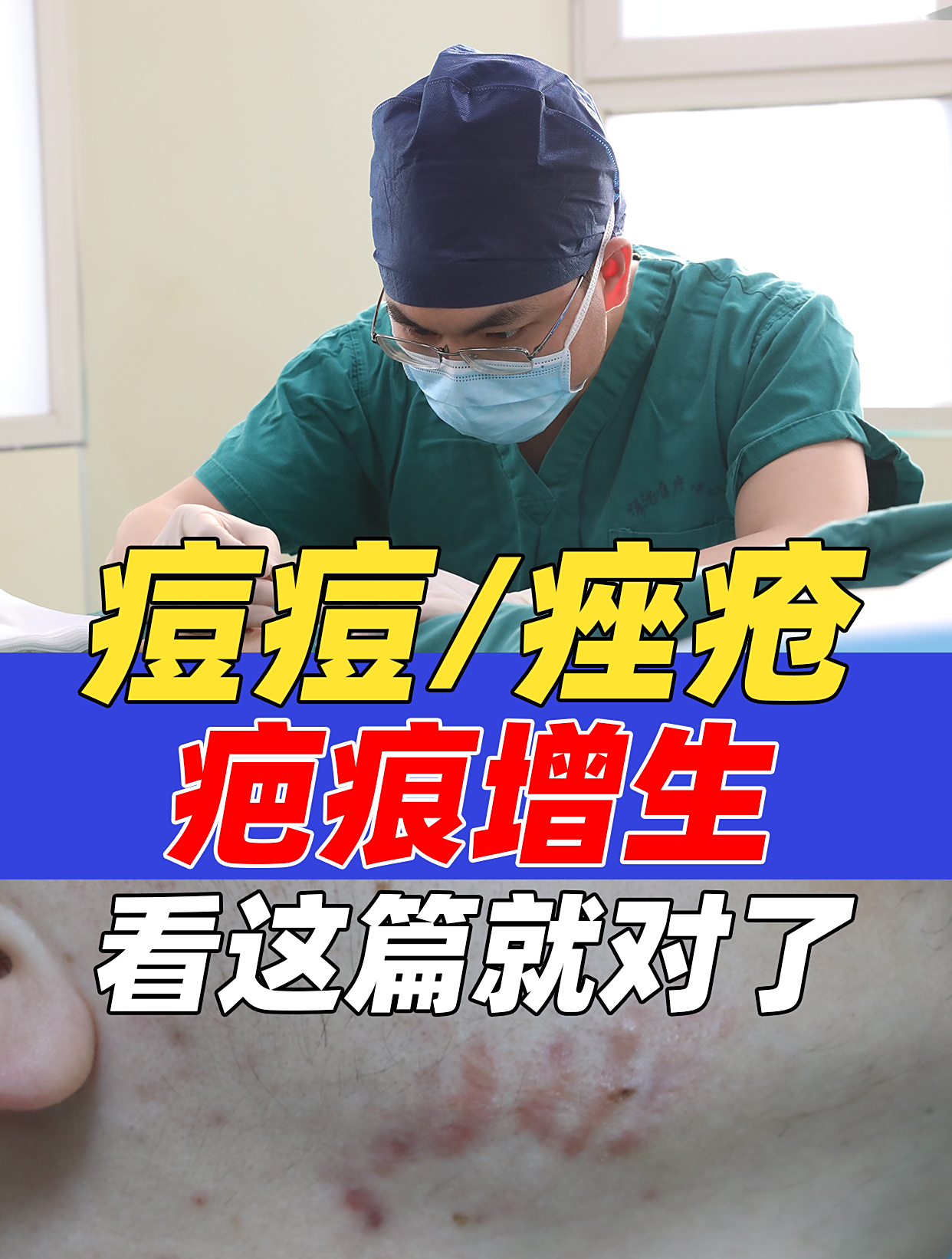 痘痘和痤疮增生了怎么办?