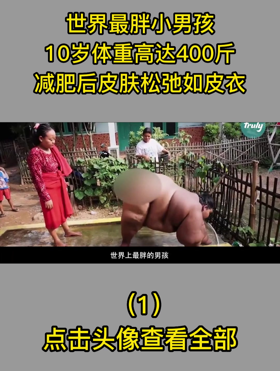 世界最胖小男孩,10岁体重高达400斤,减肥后皮肤松弛如皮衣1