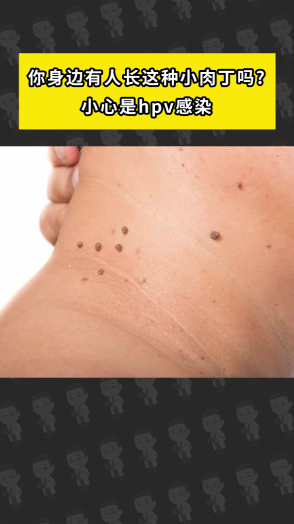 你身边有人长这种小肉丁吗?小心是hpv感染