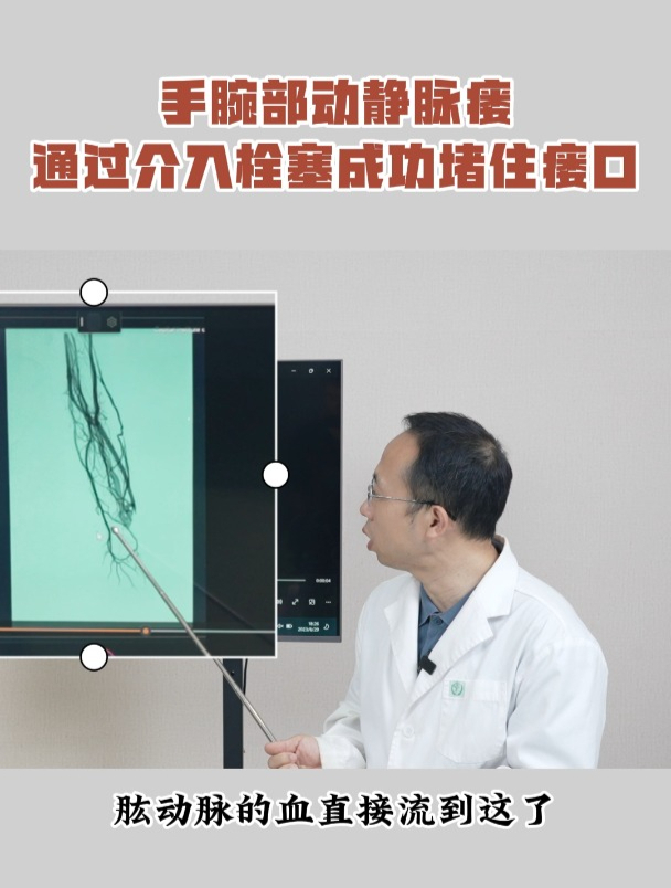 手腕部动静脉瘘,通过介入栓塞成功堵住瘘口