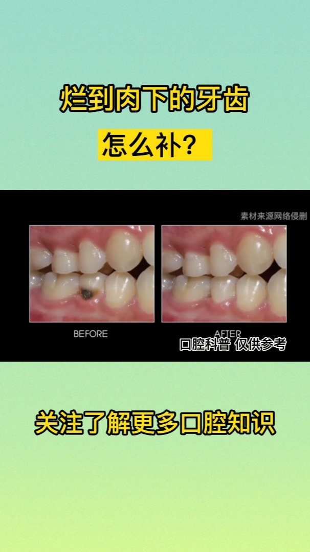 烂到肉下的牙齿如何补?看了这个视频你就知道啦!