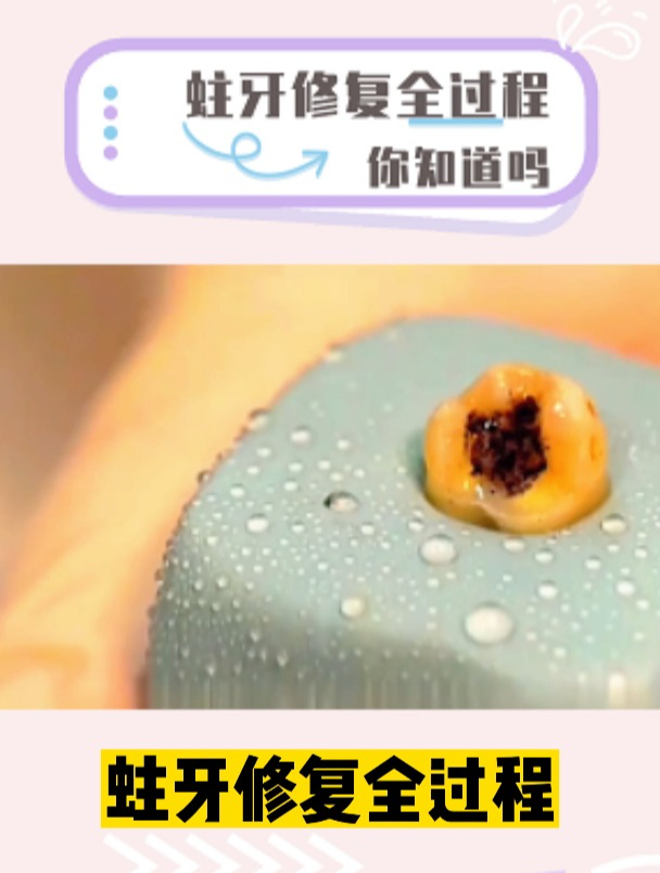 蛀牙修复全过程!