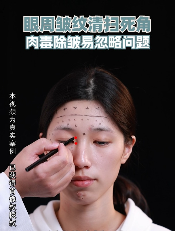 肉毒素注射除皱:眼周皱纹也有死角哦!