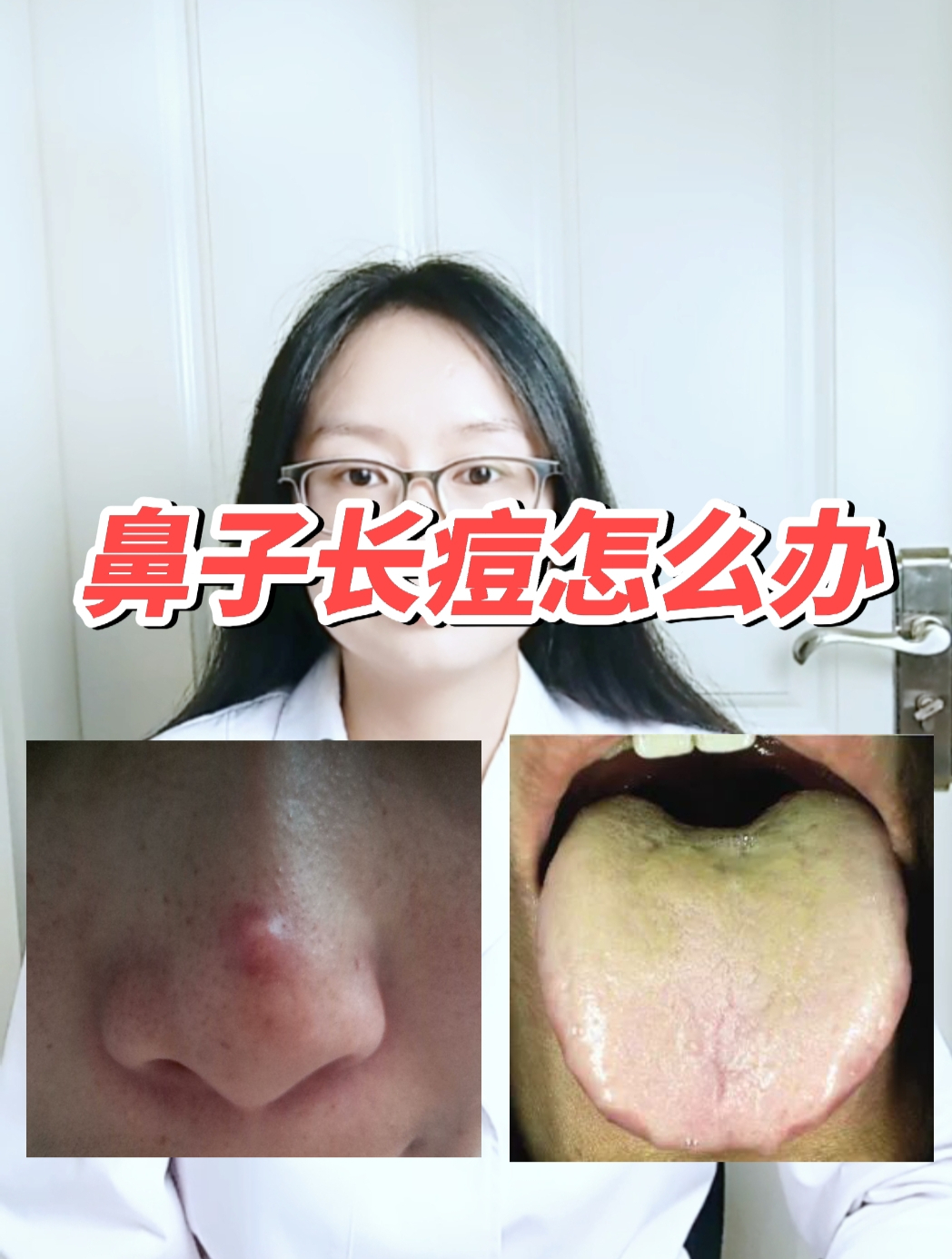 鼻子上长痘痘怎么去掉?鼻子长痘痘怎么消除