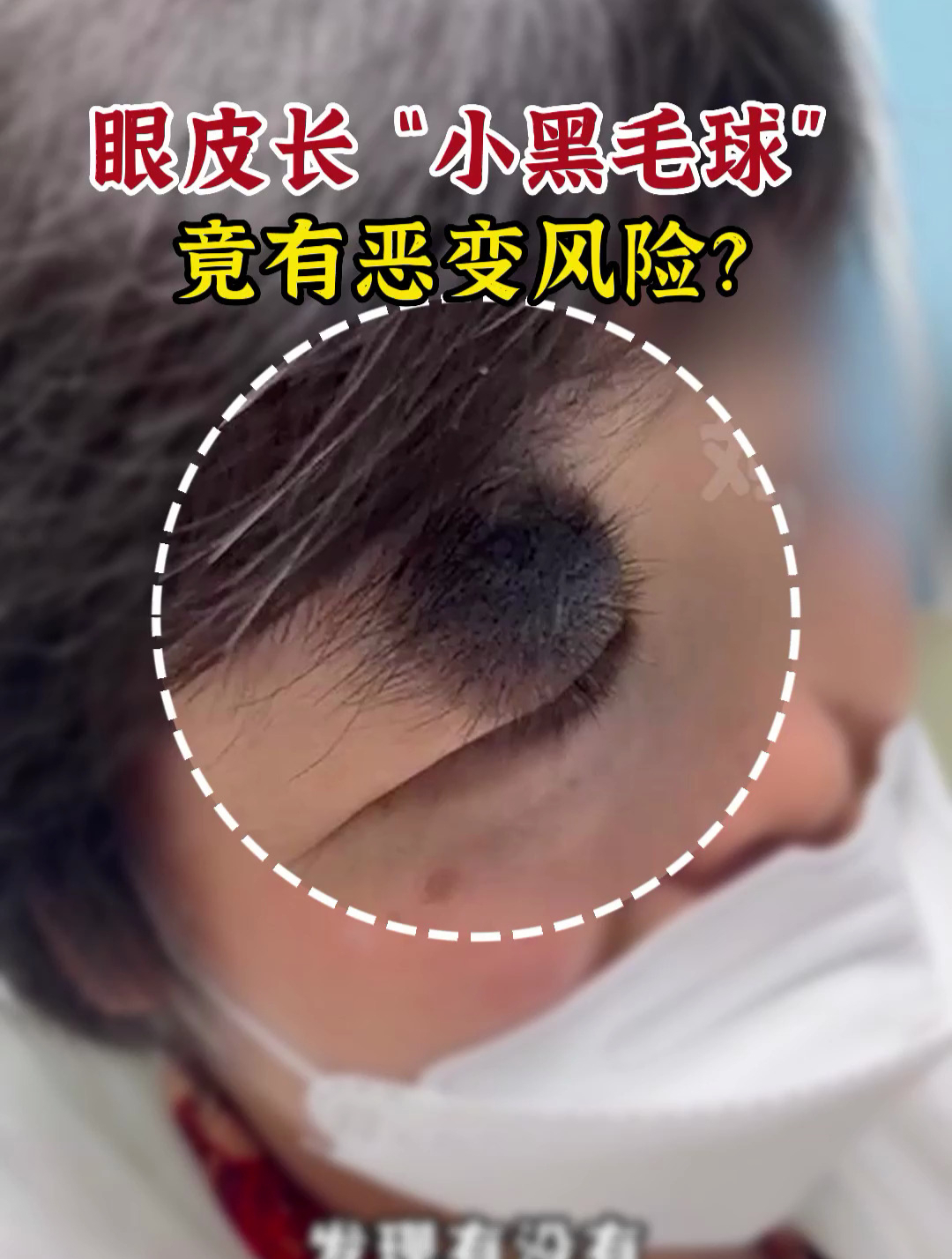 眼皮长“黑色毛球”,竟有恶变风险?