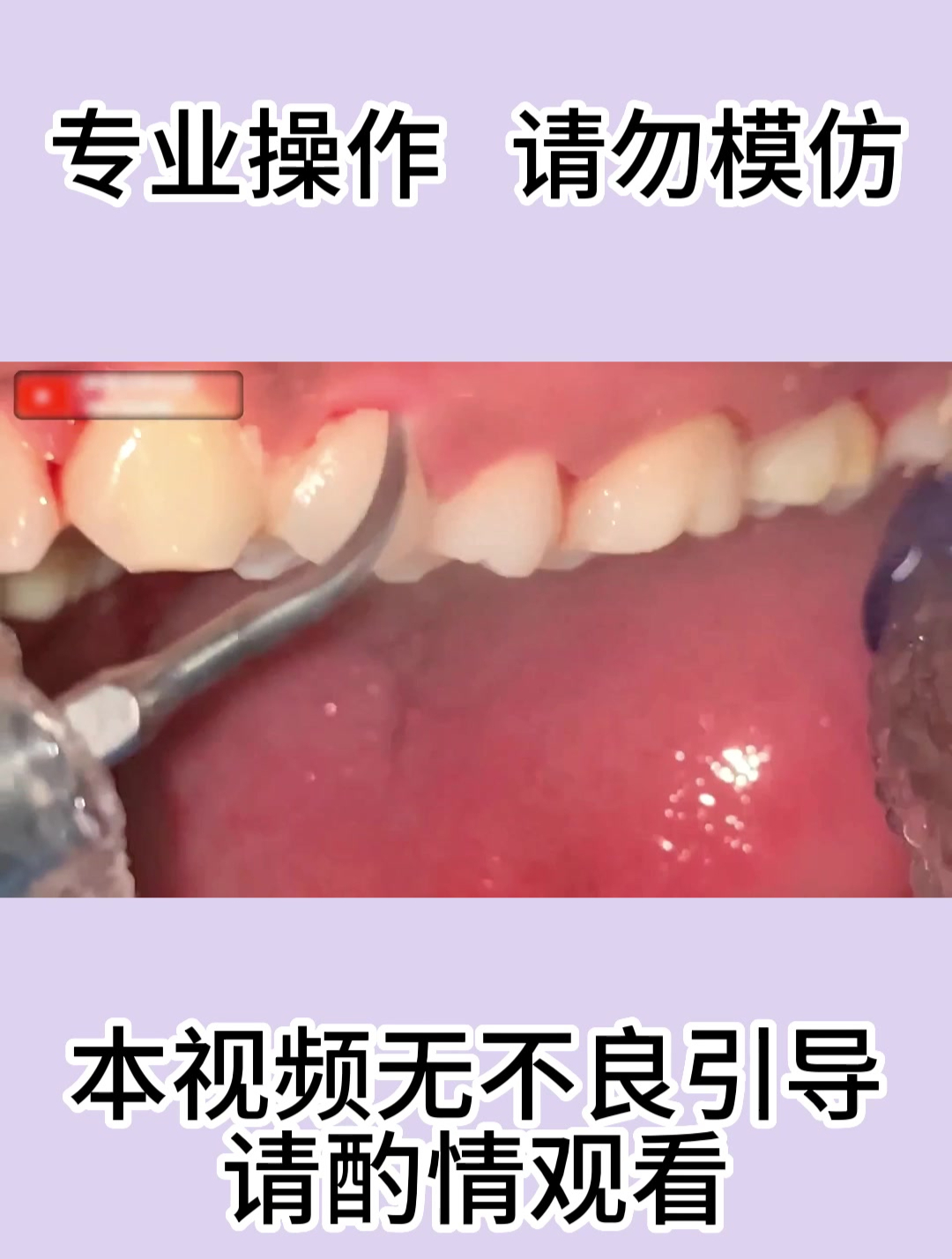 陪朋友去洗牙,牙齿上都长肉了,牙医都震惊了!