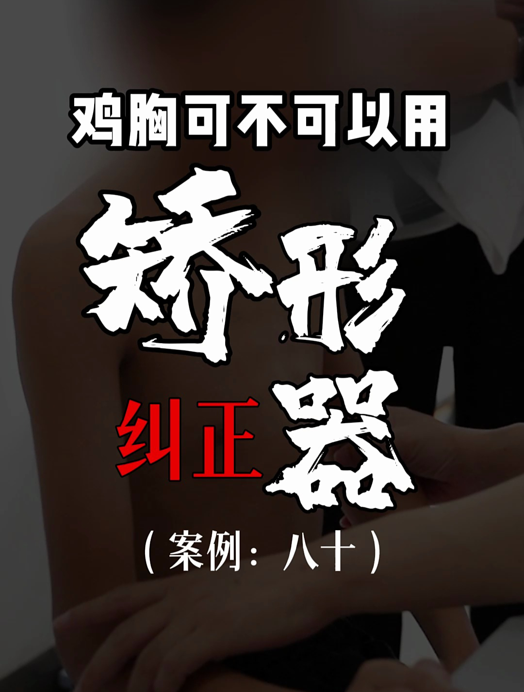 鸡胸可以用矫形器纠正吗