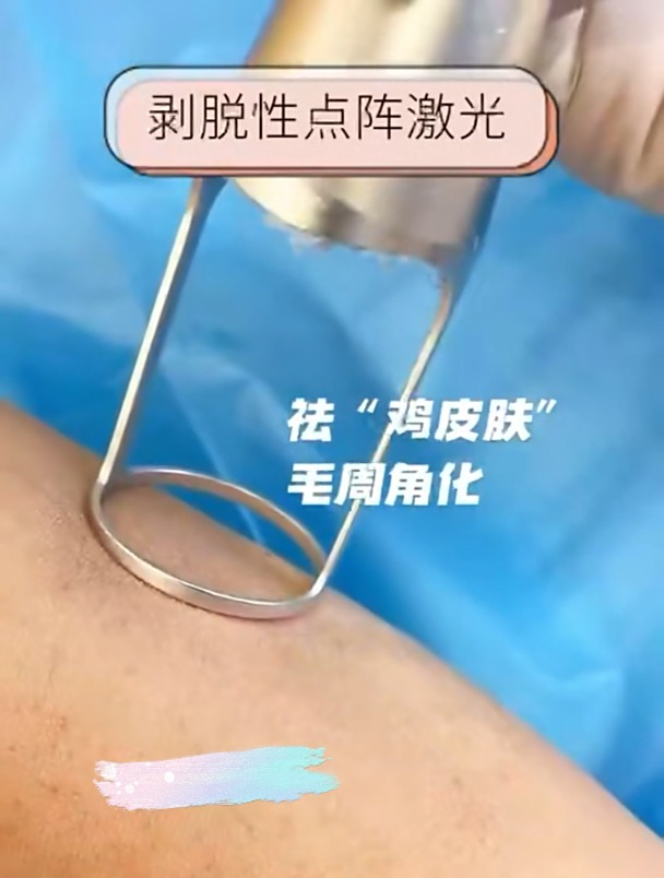 上海江城-剥脱性激光去除“鸡皮肤”