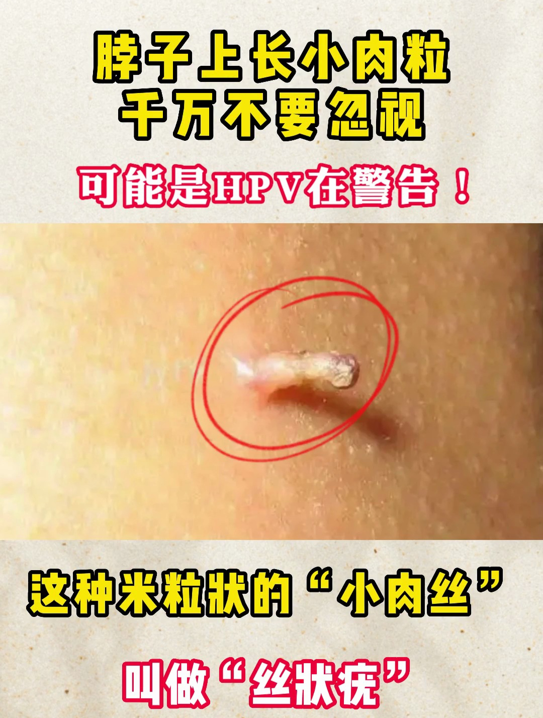 脖子上长小肉粒,可能是HPV在警告!