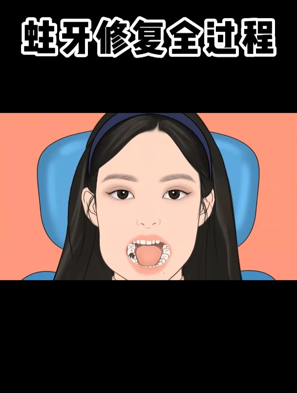 蛀牙修复全过程~