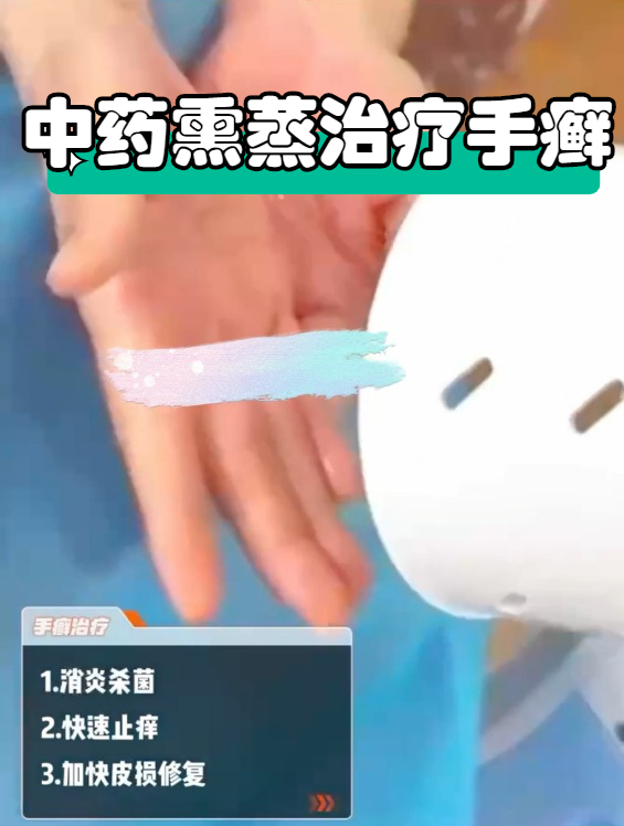 上海江城|中药熏蒸治疗手癣