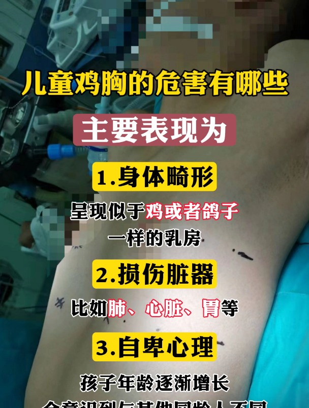 儿童鸡胸的危害有哪些?