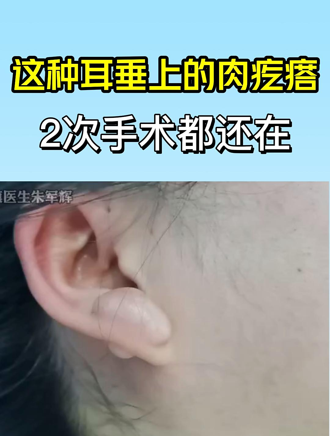 这种耳垂上的肉疙瘩,做过两次手术都没用