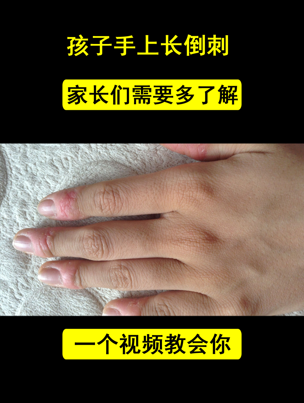 孩子手上长倒刺,可能不仅缺乏维生素,还有这些原因