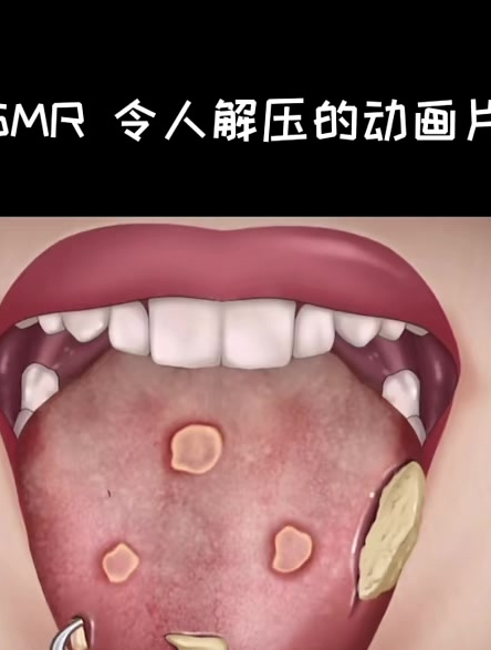 ASMR 治疗嘴部的动画片 去除结石 清除管理过程 超解压清洁