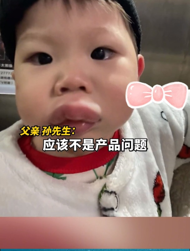1岁男孩餐后过敏肿成可达鸭,爸爸:孩子吃的尽量自己做!