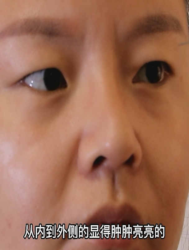 易水肿体质与肌肉肥厚导致的肿眼泡 双眼皮术前分析