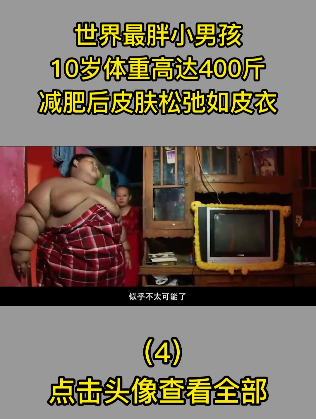 世界最胖小男孩,10岁体重高达400斤,减肥后皮肤松弛如皮衣4