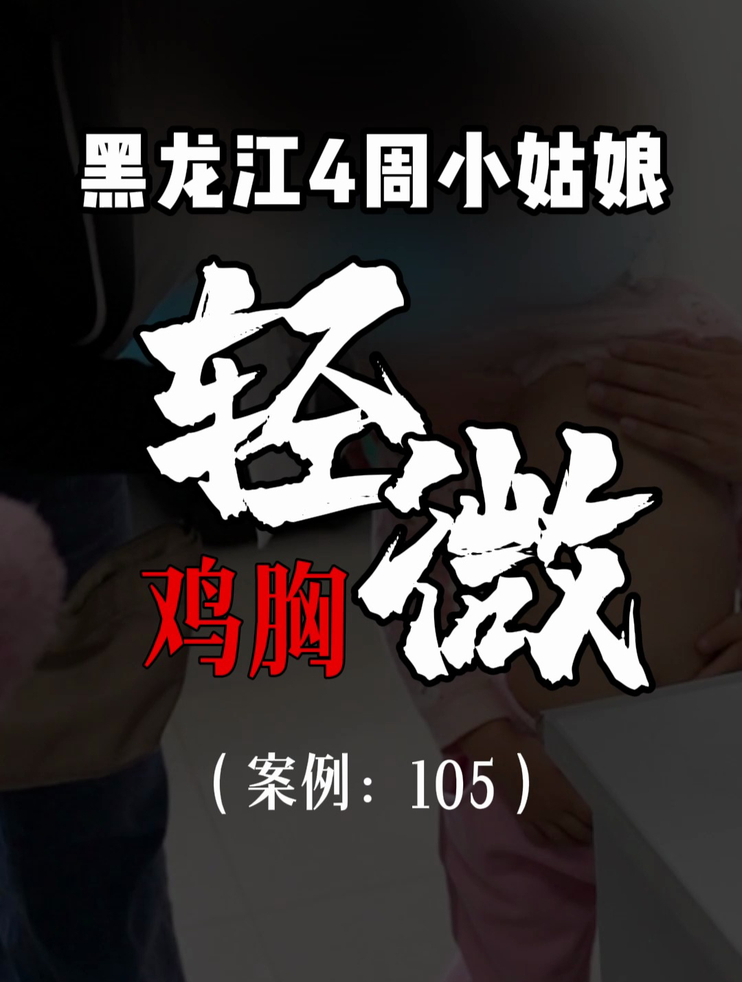 漏斗胸鸡胸医生张东升