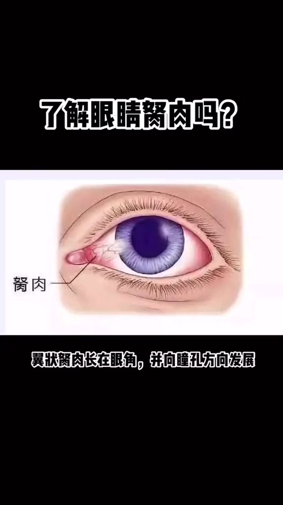 你们了解胬肉吗?