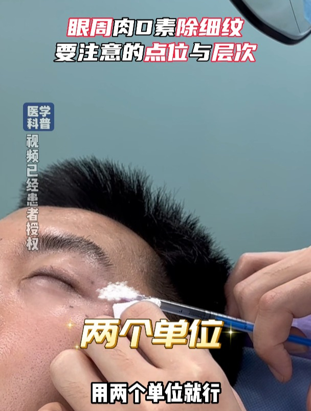 肉毒素眼周除皱点位和层次解析