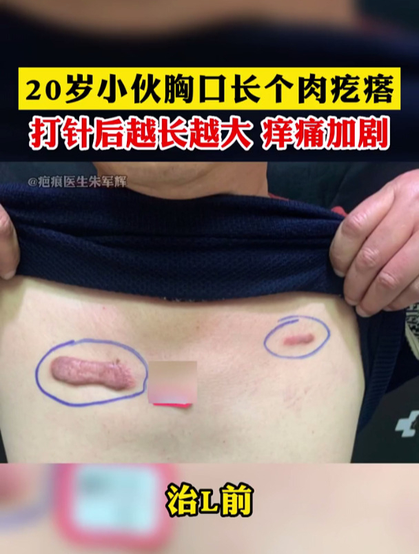 小伙胸口有块肉疙瘩痒痛加剧,打针后还在长大