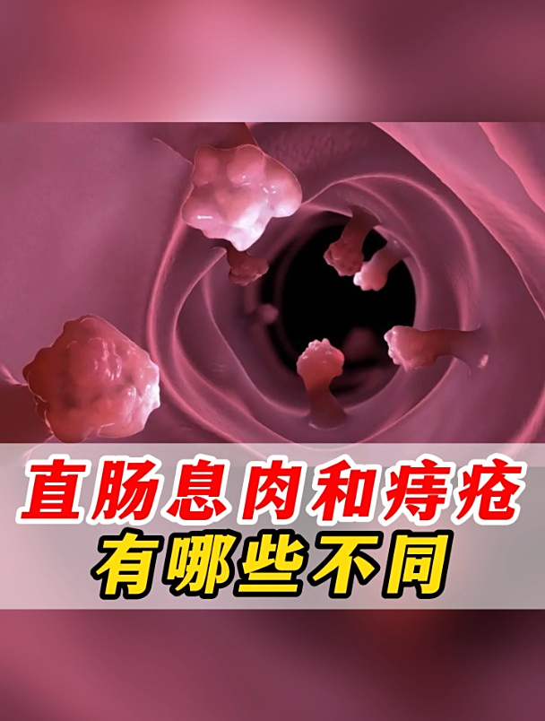 直肠息肉和痔疮有哪些不同